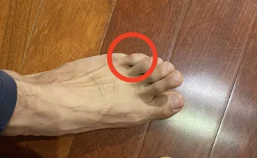 How to move your pinky toe independently and its benefits