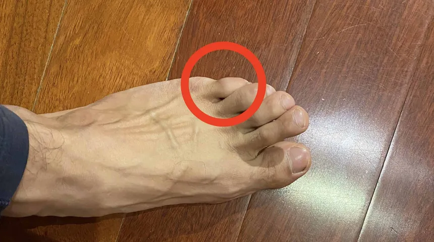 How to move your pinky toe independently and its benefits