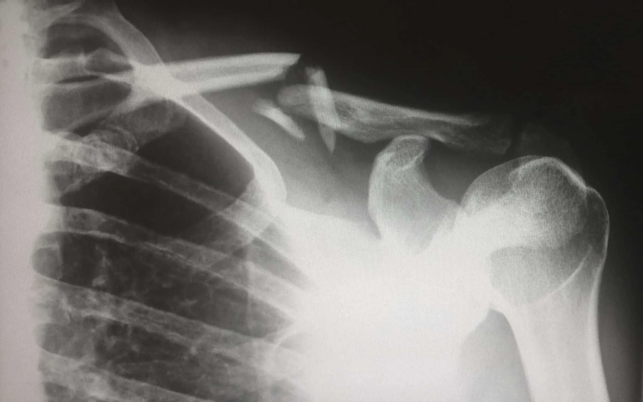 Most Common Injuries in Capoeira and why we Get Them